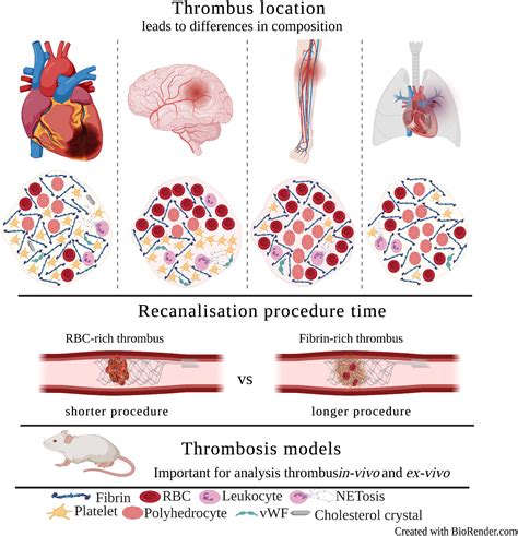 Thrombus Structural Composition in Cardiovascular Disease ...