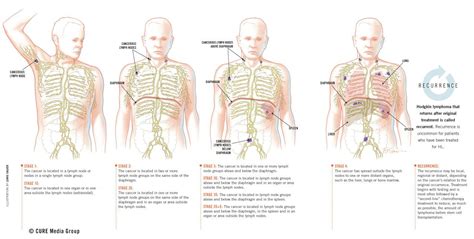 I was stage 4, the survival rate is 65% however after my stem cell ...