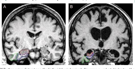 Figure 1 from Medial temporal lobe atrophy on MRI scans and the ...