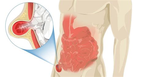 Inguinal hernia - Symptoms, Causes and Treatment