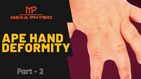 Ape Hand Deformity - part 2 | Signs & Symptoms, Treatment | In Hindi ...