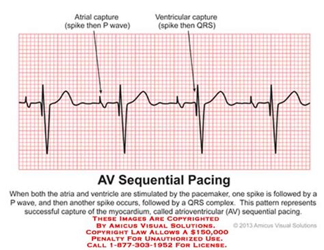 AV Sequential Pacing