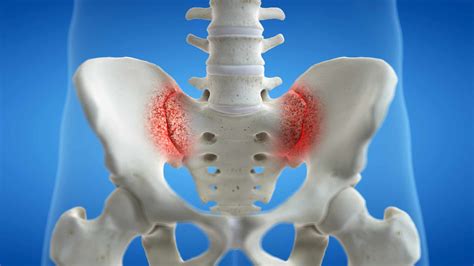 Sacroiliac Joint Injection