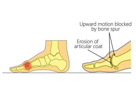 What is Hallux Rigidus & Its Impact on Toe Movement? - Upswing Health