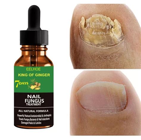 Nail Fungus Treatment Brampton at James Waltz blog