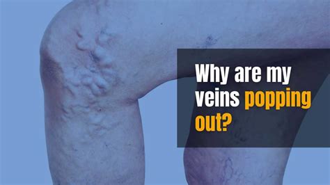 Why are my veins popping out? - Wapomu Health & Wellness