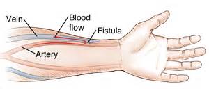 What Is A Fistula For Dialysis Pictures - PictureMeta