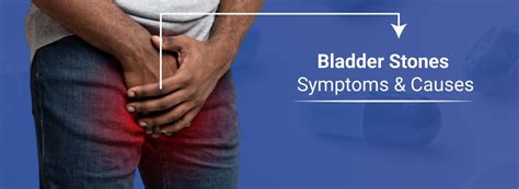 Bladder Stones: What You Need to Know About Symptoms & Causes