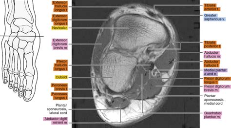 Foot Muscles Mri Anatomy Interosseous Muscles Of Foot Anatomy Plantar ...