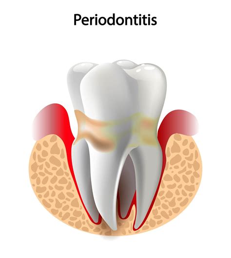 How COVID-19 Complications Can Start in the Mouth - Channo DDS