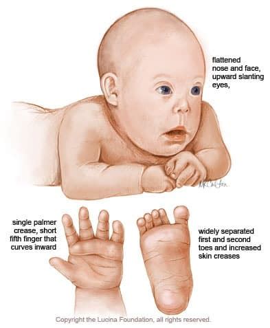 Down Syndrome: Causes, Symptoms, Treatment | SchoolWorkHelper