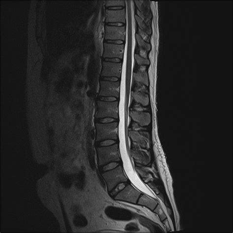 Mri Lumbar Spine Scan Sagittal View Lumbosacral Spine Has Straightening ...