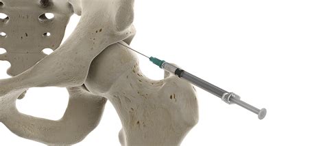 Sacroiliac (Si) Joint Injections in MD | Synergy Spine & Pain Center