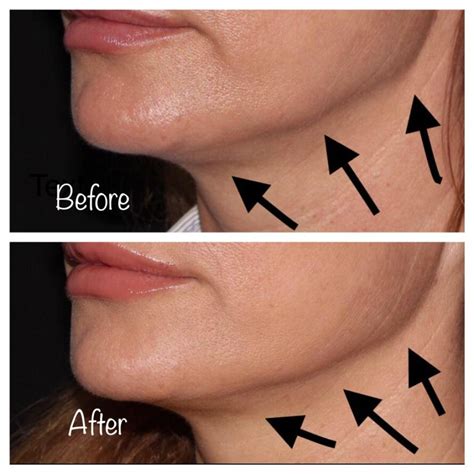 Nefertiti Lift : REDUCE JOWLS AND CONTOUR YOUR JAWLINE WITH BOTOX ...