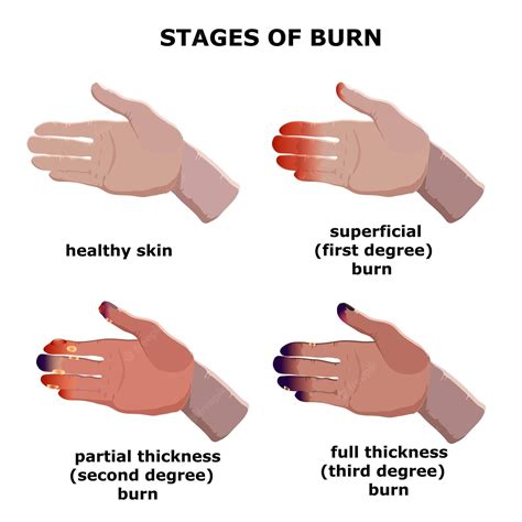 Stages of second degree burn healing - fessspa