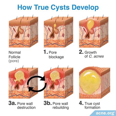 What Is an Acne Cyst? - Acne.org