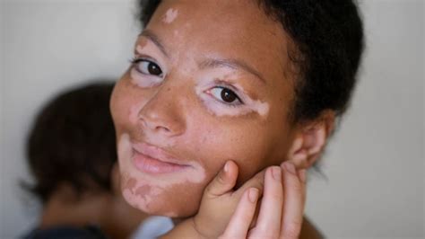 How to detect vitiligo? Know signs and symptoms of skin condition that ...