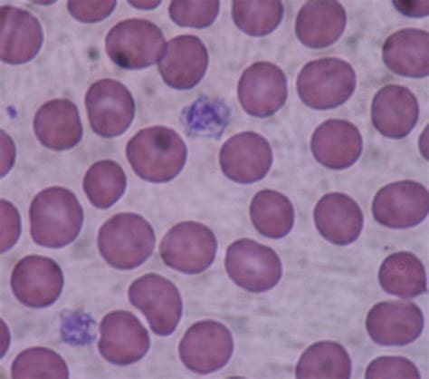 File:Giant platelets.JPG - Wikimedia Commons