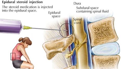 Epidural Steroid Injection Side Effects | Side Effects Of Epidural ...