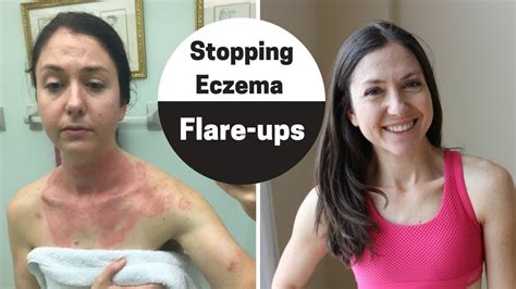 How to handle eczema flare-up (My 4 step checklist to clear skin ...