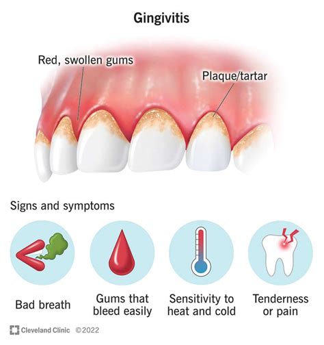 Gingivitis: Symptoms & How To Treat It