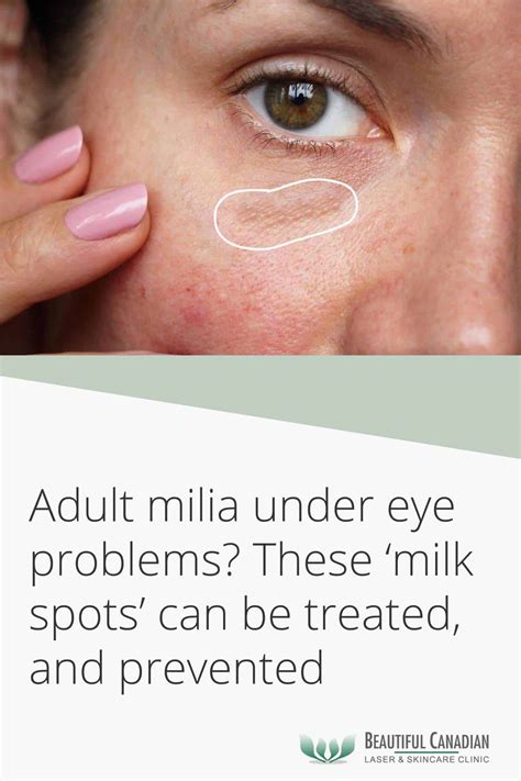 Surrey Adult Milia Under Eye Treatment | Remove Milia, Milk Spots ...