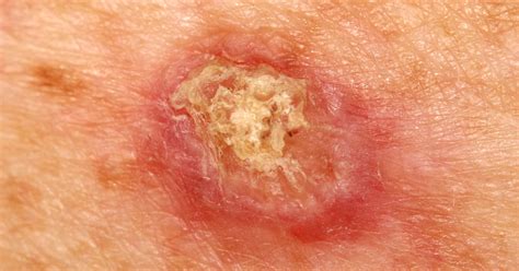 Squamous Cell Carcinoma: Causes, Symptoms, Prevention, Diagnosis ...