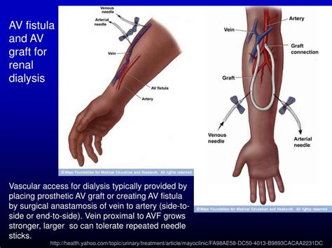 Dialysis Fistula Diagram