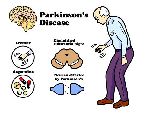 parkinson's disease may be stopped