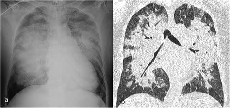 Pulmonary Edema X Ray Butterfly Pattern