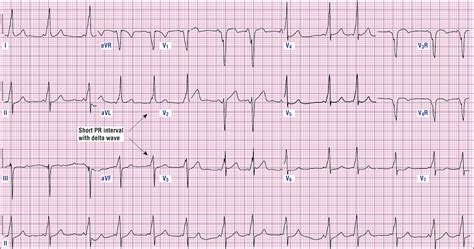 Sinus Ventricular Tachycardia