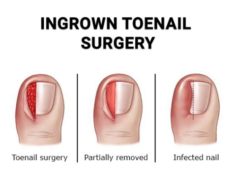 Ingrown Toenail Treatments - Foot Doctors in Clifton, NJ & Wayne, NJ