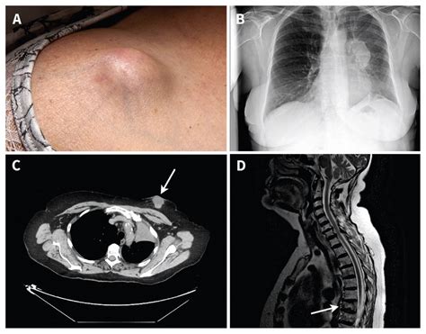 Metastatic lung cancer presenting as cutaneous nodules | CMAJ