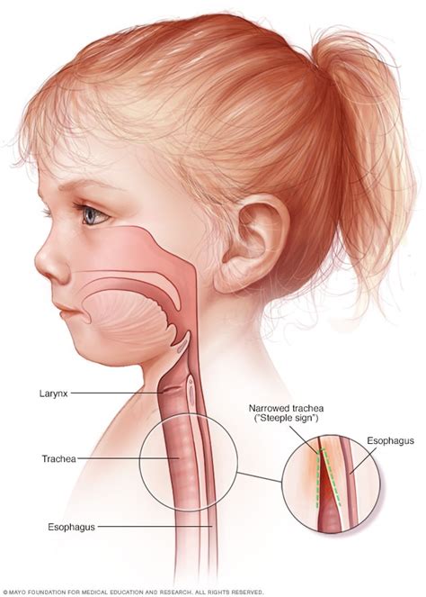 Croup - Symptoms and causes - Mayo Clinic