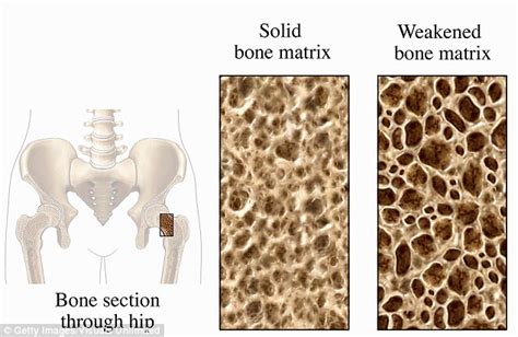 Air pollution exposure linked to brittle bone disease | Daily Mail Online