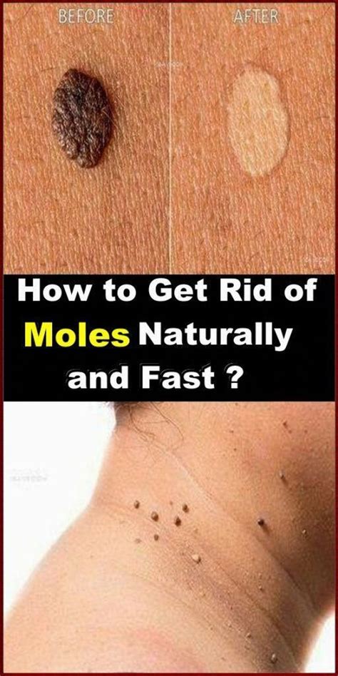 Type of Skin Moles - Healthy Medicine Tips | Skin moles, Mole removal ...