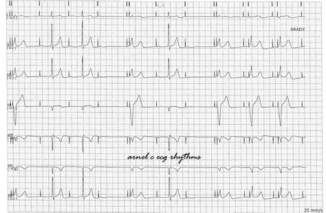 ECG Rhythms: Managed Ventricular Pacing