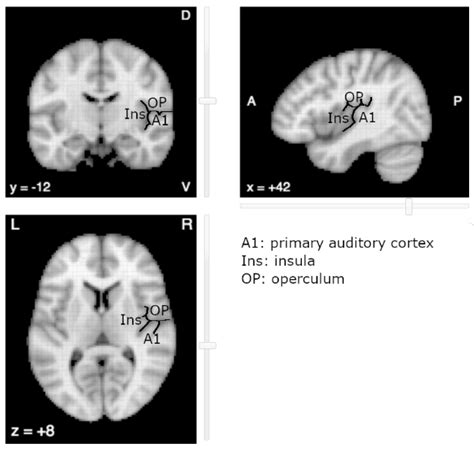 Auditory Cortex Mri