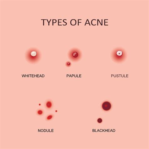 Different Types Of Acne Scars