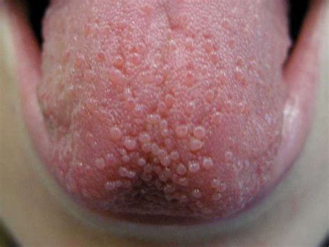 Tongue bumps: Causes, when to see a doctor, and treatment