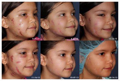 Scar Treatment San Diego, CA | Cosmetic Laser Dermatology