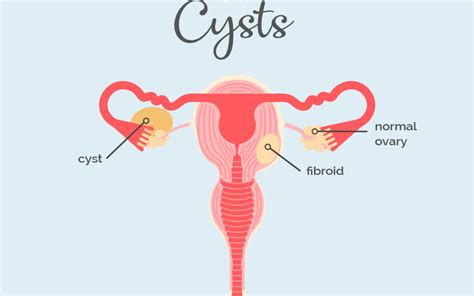 Fibroids vs Cysts - Fibroid Treatment Clinic