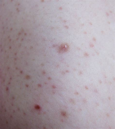 What Causes Keratosis Pilaris In Children & How To Treat It?