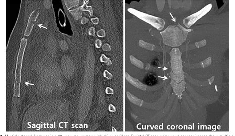 Figure 2 from Traumatic Sternal Fracture: Incidence, Causes, and CT ...