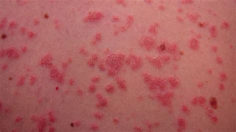 Guttate Psoriasis: Causes, Diagnosis & Treatments