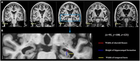 Frontiers | Executive function deficits and medial temporal lobe ...