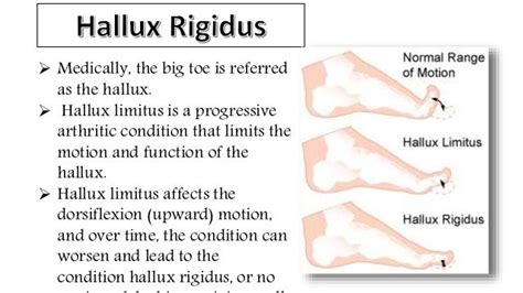 Hallux Rigidus Pictures - PictureMeta