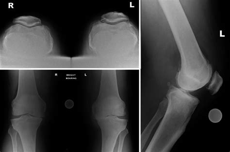 Fig. 28.6, [Bilateral knee osteoarthritis primarily affecting ...