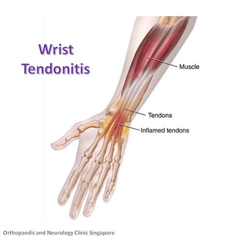 Wrist Tendonitis [solution] | Meticulous Wrist Clinic