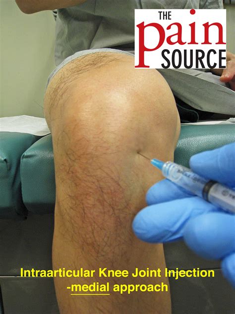 Intraarticular Knee Joint Injection – Technique and Tips - The Pain ...